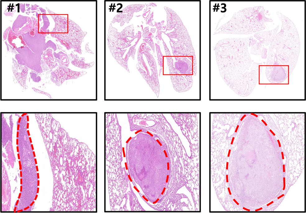 Lung cancer H&E staining